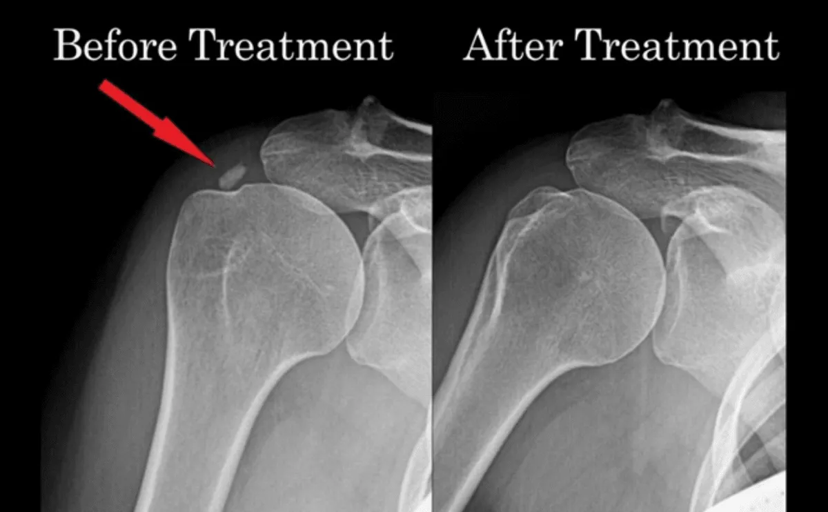 Two shoulder X-rays side by side: before treatment, an arrow points to a bright calcium deposit above the ball of the shoulder; after treatment, the deposit is gone.