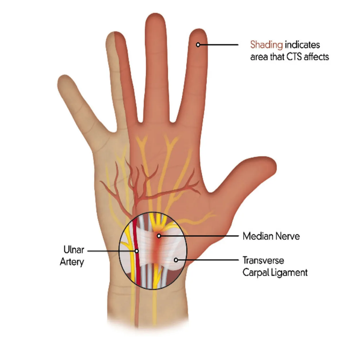 Diagram of the hand showing the median nerve passing under the transverse carpal ligament at the wrist.