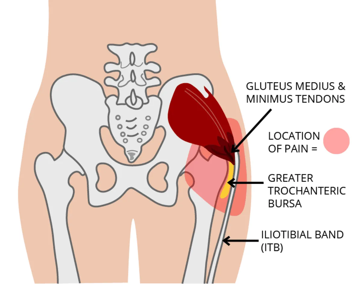 Diagram of the outer hip showing the gluteus medius and minimus tendons, the greater trochanteric bursa, and the iliotibial band.
