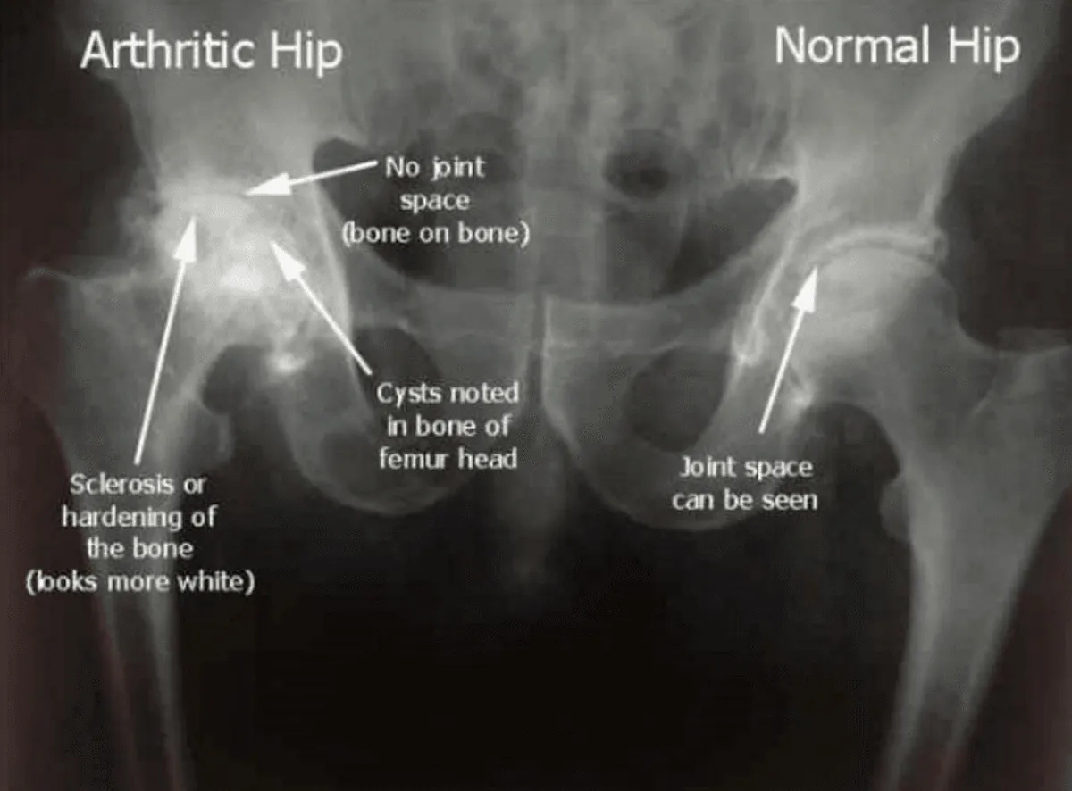 Pelvis X-ray comparing an arthritic hip with lost joint space to a normal hip.