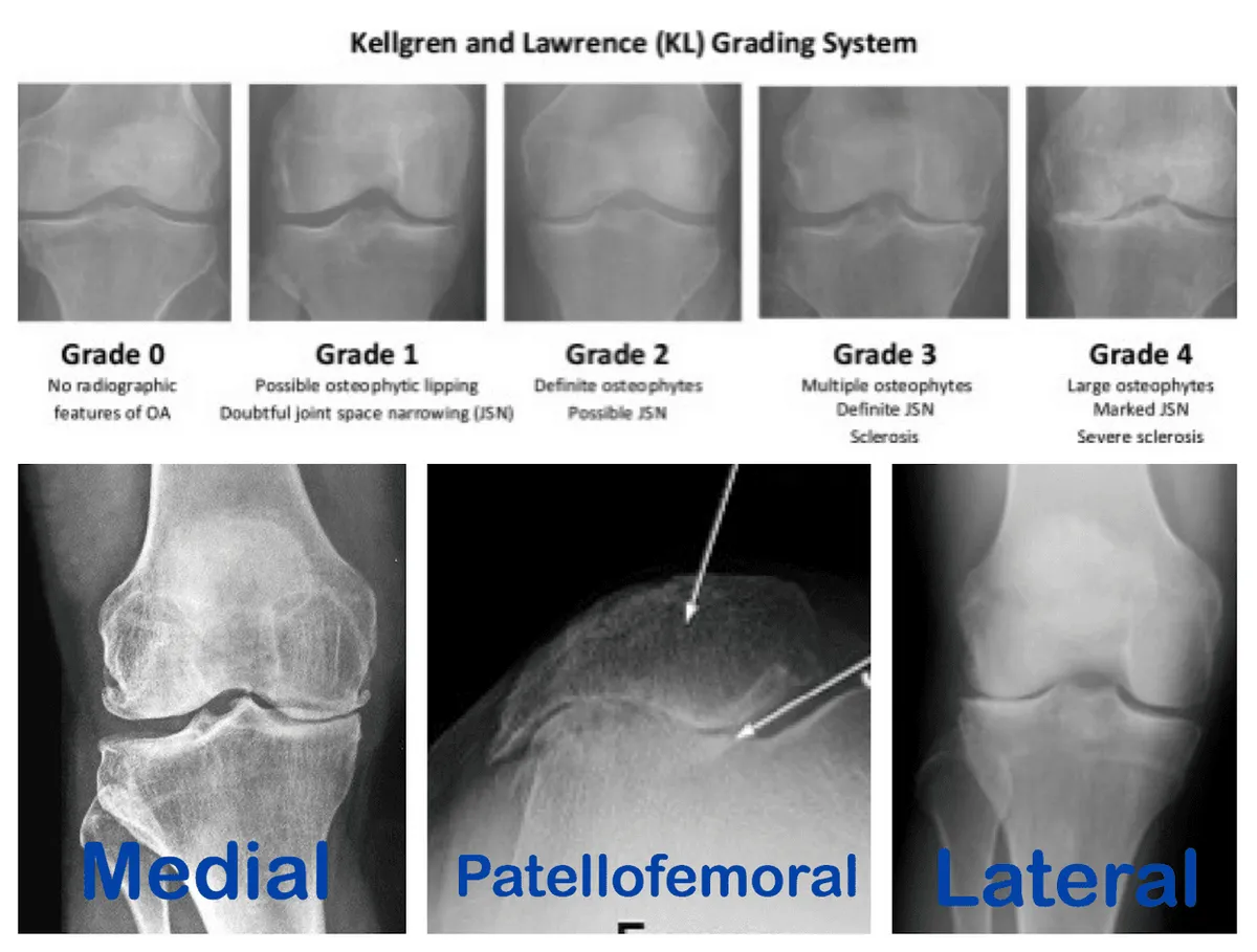 Knee X-rays showing the Kellgren and Lawrence grades of osteoarthritis, from grade 0 to grade 4.