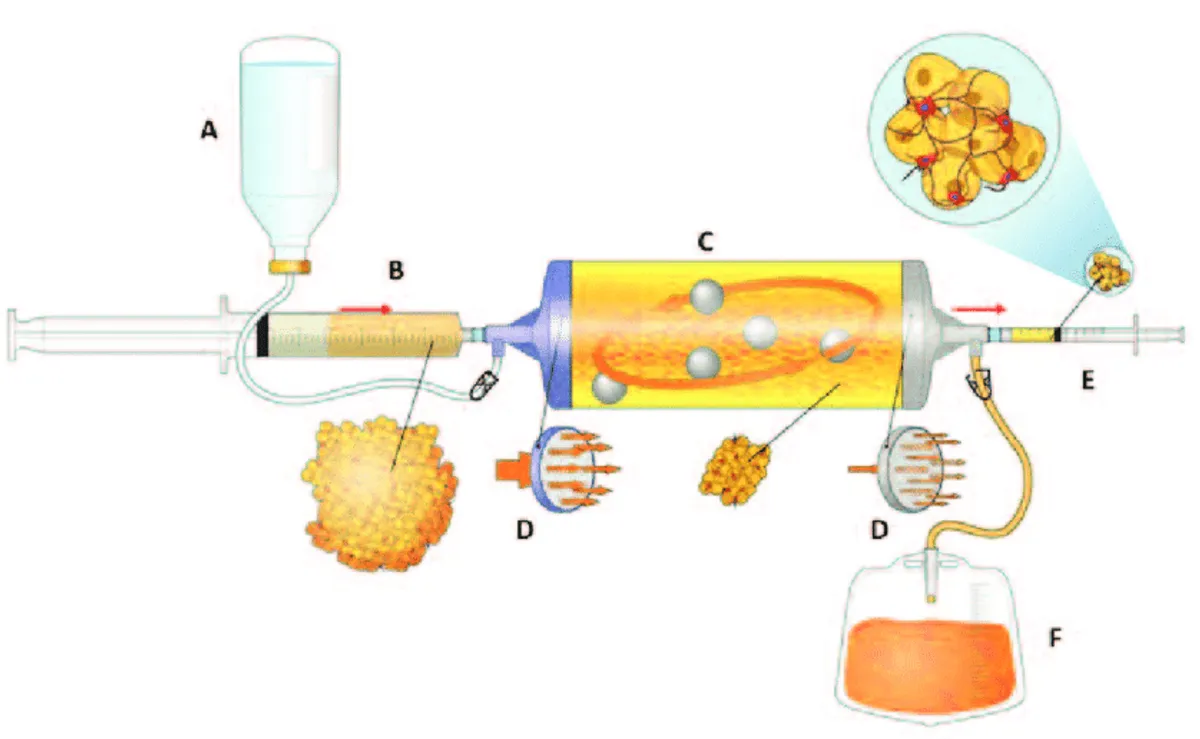 Diagram of the closed processing device that rinses and gently breaks down fat tissue before injection.
