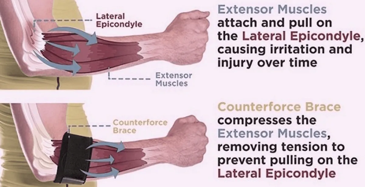Diagram of the forearm extensor muscles pulling on the lateral epicondyle, and a counterforce brace compressing those muscles.