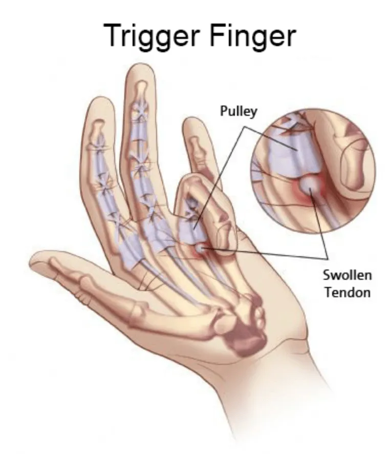 Diagram of a finger showing a swollen flexor tendon catching on its pulley.