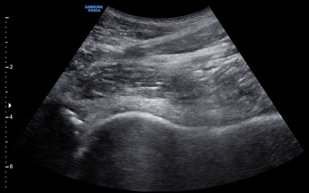 Diagnostic musculoskeletal ultrasound image of a hip